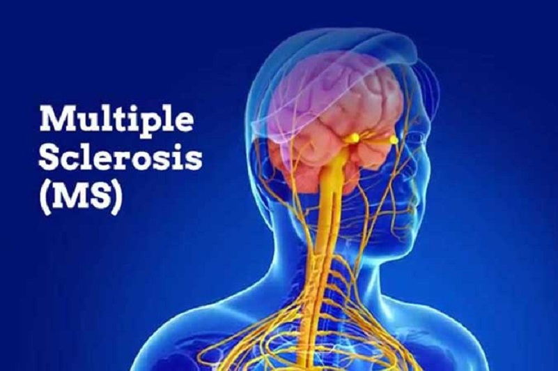 بیماری ام اس