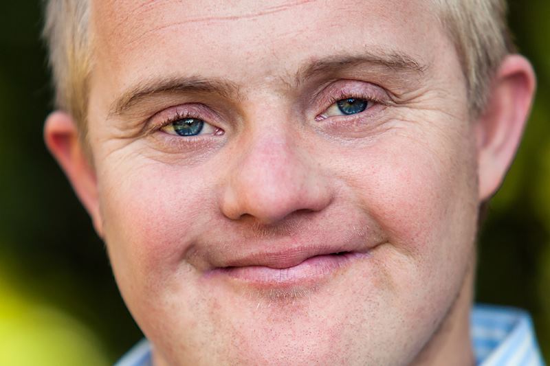 سندروم داون