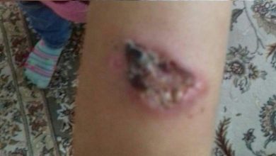 انتقاد به سالک درباره‌ی شیوع سالک