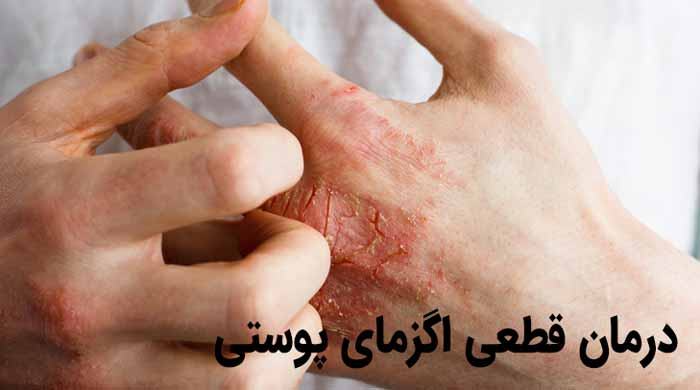 روشهای درمان اگزمای پوستی